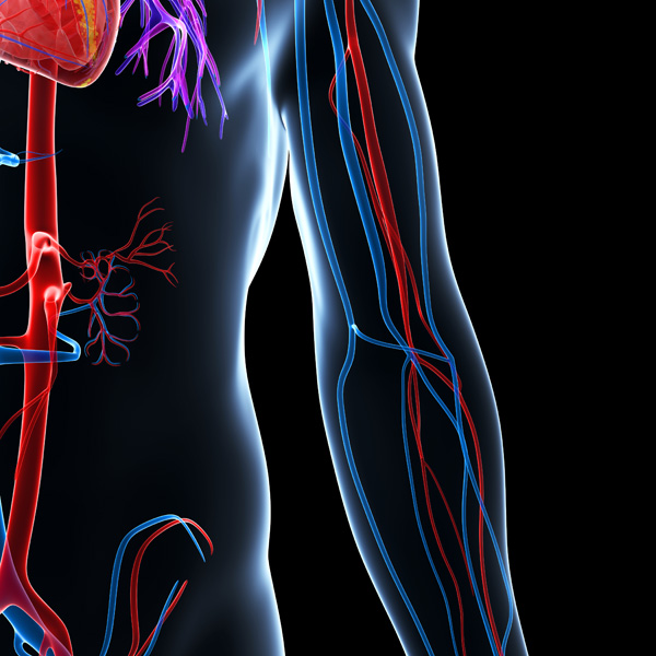 What is an AV fistula?