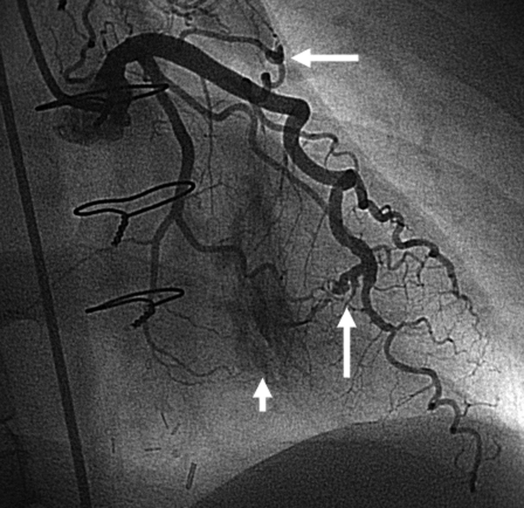Vascular access flow problems